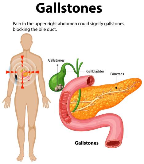Gallstones explained – Mr Di Maggio