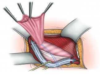 Understanding inguinal hernias