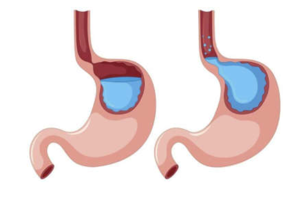 Laparoscopic Anti-Reflux Surgery