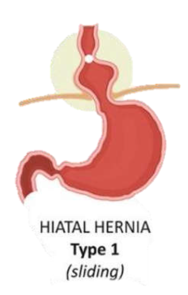 Laparoscopic Anti-Reflux Surgery