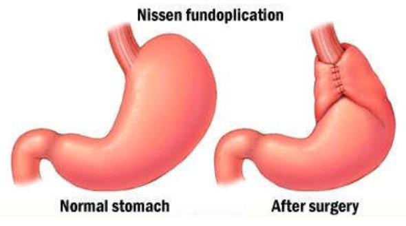 Laparoscopic Anti-Reflux Surgery