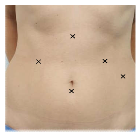 Laparoscopic Anti-Reflux Surgery