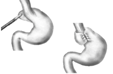 Laparoscopic Nissen Fundoplication