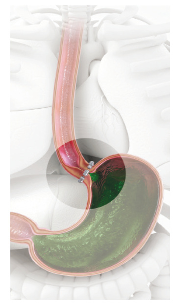 LINX magnetic sphincter augmentation device