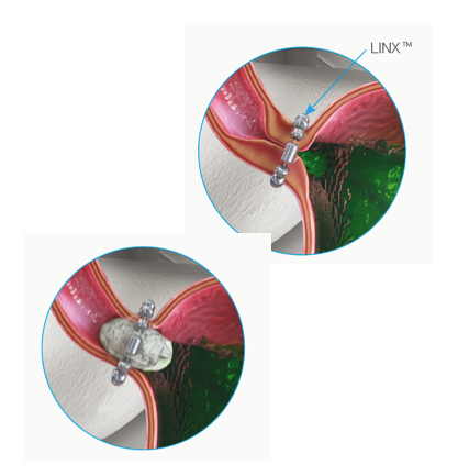 LINX magnetic sphincter augmentation device