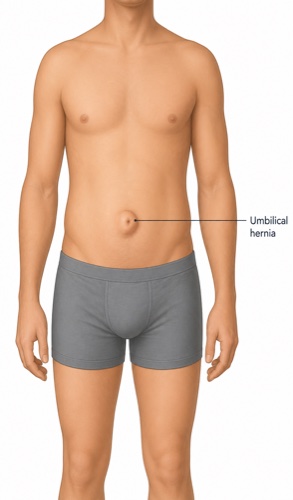 Umbilical hernia repair in adults